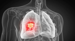 Phát hiện nguyên nhân gây ung thư phổi chưa từng biết