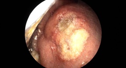 Vết loét nhỏ tưởng vô hại, hóa ung thư lưỡi