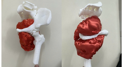 Đau háng kéo dài, người đàn ông bị phát hiện ung thư xương ác tính