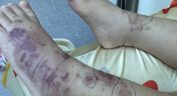 Chuyên gia cảnh báo về một căn bệnh nguy hiểm, lây lan nhanh, tỉ lệ tử vong cao