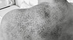 Người phụ nữ nhập viện cấp cứu sau khi chích lể, giác hơi