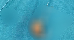 Người phụ nữ phát hiện sự thật sau 22 năm đặt vòng tránh thai