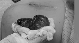 Thai 34 tuần, phát hiện u buồng trứng chèn ép