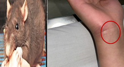 Nam sinh mắc bệnh nguy hiểm từ vết chuột cắn