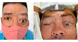 Một ca bệnh mà Bệnh viện Tai Mũi Họng TPHCM mới gặp lại trong vòng 20 năm 