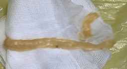 Sán dây gần 1 m “ngọ nguậy” trong đại tràng thanh niên mê đồ tái