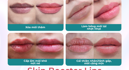 Top 3 nơi "trẻ hóa môi" uy tín tại TPHCM