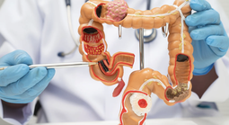 Đau bụng kéo dài, cụ bà 72 tuổi nhập viện trong tình trạng viêm phúc mạc toàn thể