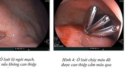 16 tuổi đã xuất huyết dạ dày và cảnh báo từ bác sĩ