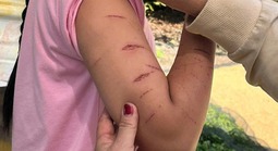 Vụ nữ sinh bị chị họ gây thương tích: Giao "thủ phạm" cho nhà trường, gia đình quản lý