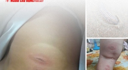 Sự thật vụ việc bé 3 tuổi "bị sâu biển cắn nguy kịch"