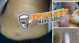 Thực hư thông tin bé 3 tuổi bị sâu biển cắn nguy kịch, gia đình tha thiết kêu gọi hỗ trợ máu hiếm