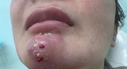 Tin quảng cáo “bật tông nhanh”, nhiều người biến dạng mặt vì làm đẹp cận Tết