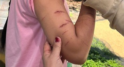 Sở Y tế tỉnh Cà Mau thông tin về vụ nữ sinh bị chị họ gây thương tích