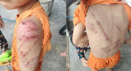 Xót xa hình ảnh cháu trai nghi bị cha đánh bầm tím khắp người