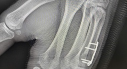 Nam sinh gãy xương bàn tay sau cú đấm boxing