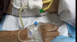 Cụ ông nhiều ngày bí tiểu, nước tiểu trắng đục như sữa