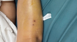 Tây Ninh: Phun thuốc cỏ, người phụ nữ bị rắn cắn nguy kịch