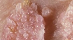 Người đàn ông gần 70 tuổi mắc sùi mào gà sau quan hệ không an toàn