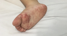 Dịch tay chân miệng “nóng” trở lại, trẻ nhỏ đối mặt nguy cơ biến chứng nặng