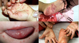 Sốt xuất huyết tăng 2,2 lần, tay chân miệng gấp 5 lần