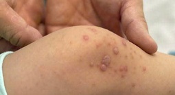 Bệnh tay chân miệng tăng nhanh, bác sĩ cảnh báo nóng