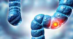 Phát hiện virus mới liên quan loại bệnh ung thư phổ biến