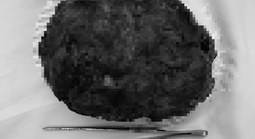 Cô gái trẻ về nước mổ u vú 17 cm, giữ được “vòng một”