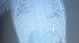 Dị vật sắc nhọn nằm trong dạ dày bệnh nhi 21 tháng tuổi