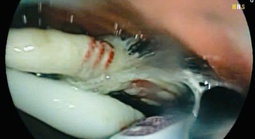 Người đàn ông nuốt cùng lúc 3 bàn chải đánh răng vào bụng