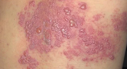 Zona có thể khiến 1/3 người trưởng thành mắc trong đời