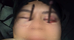 Cứu nam thanh niên bị 2 chiếc đũa đâm sâu vào 2 hốc mắt