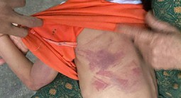 Bé gái lớp 2 bị bạn cùng lớp dùng thước đánh thâm tím người vì không cho kẹo