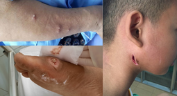 Bộ Y tế nói gì về bệnh "sốt đất" (Whitmore) sau 23 ca tử vong ở Thái Lan?