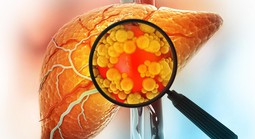 Đảo ngược gan nhiễm mỡ không cần ăn kiêng: Đột phá từ Mỹ
