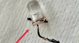Bác sĩ thót tim gắp đèn LED nằm trong phế quản bé 9 tháng tuổi