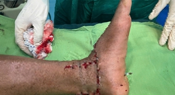 Lưỡi máy phát cỏ gãy, chém đứt lìa bàn chân người đàn ông