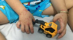 Sốt xuất huyết, tay chân miệng tăng trong tháng 4
