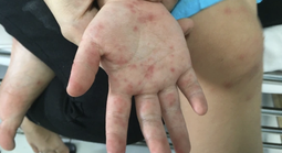 Làm gì để giảm nguy cơ tử vong và di chứng do bệnh tay chân miệng?