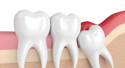 Nhổ răng khôn có được BHYT chi trả?