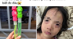 Bé gái 5 tuổi tổn thương mắt sau khi thổi bong bóng xà phòng
