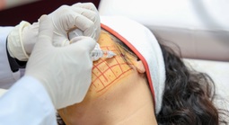 Căng chỉ làm đẹp, cô gái phải lấy dị vật dưới da