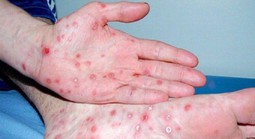 TPHCM: Số người mắc bệnh giang mai tăng đột biến
