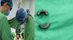 Bác sĩ tại Cần Thơ dùng máy cắt cứu người đàn ông ở An Giang gặp nạn vì “nâng cấp dương vật"