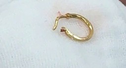 Bé gái nhập viện vì chiếc bông tai trong thực quản