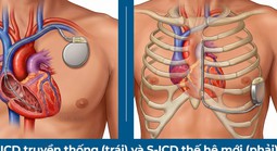Lần đầu tiên đặt máy phá rung tim công nghệ mới