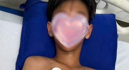 Bé trai ở Cà Mau bị ong vò vẽ đốt hơn 50 vết