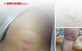 Sự thật vụ việc bé 3 tuổi "bị sâu biển cắn nguy kịch"