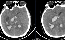 Nam sinh 15 tuổi bất ngờ đột quỵ tử vong