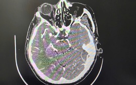 Đột quỵ khi uống bia, người đàn ông thoát chết ngoạn mục